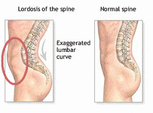 lordosis-versus-neutral-spine
